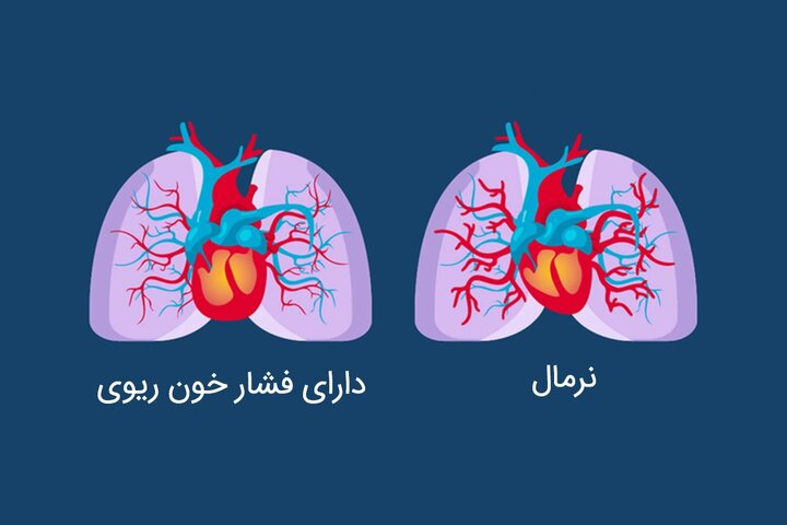 فشار خون را با توصیه‌های طب ایرانی کنترل کنید