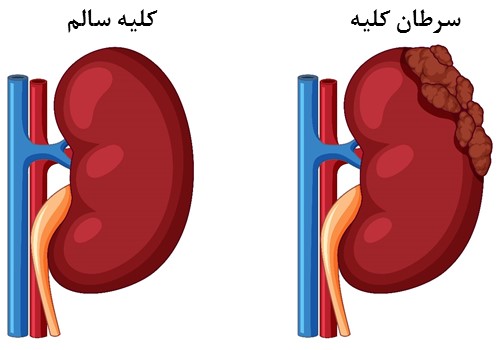 غربالگری